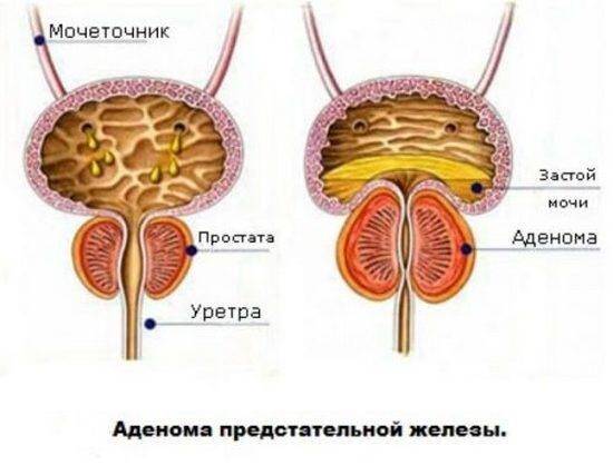 О чем говорит частое мочеиспускание у мужчин: причины, симптомы, методы лечения