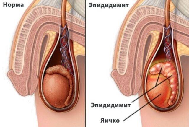 Почему болит правое яичко у мужчины