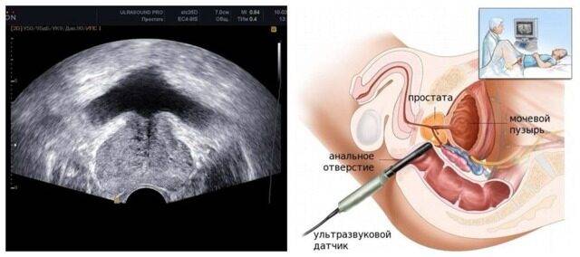 Трансректальное УЗИ предстательной железы: что показывает ультразвуковое ректальное исследование простаты?