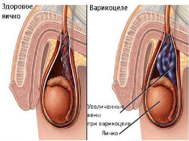 Варикоцеле яичек