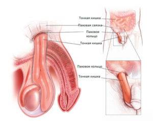грыжа яичка
