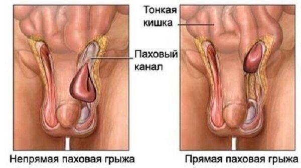 Почему болит правое яичко у мужчины