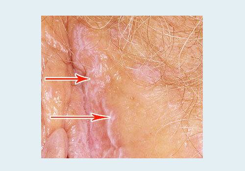 Лишай на половом члене: симптомы и лечение.