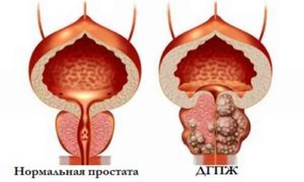 Гиперплазия предстательной железы - симптомы, лечение