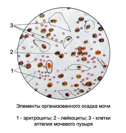 Слизь в моче у ребенка: причины, что означает наличие белка у грудничков