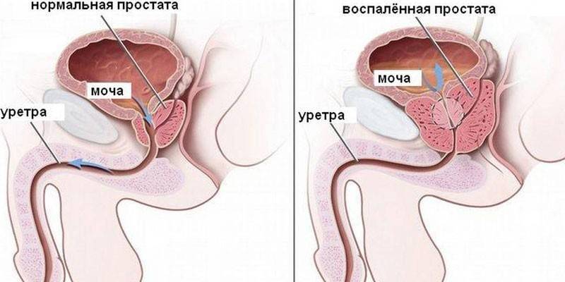 Нормальная и воспаленная простата