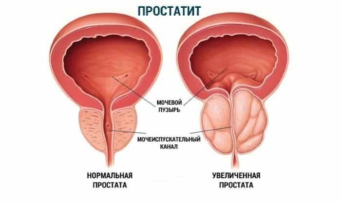 Ломфлокс назначают при простатите