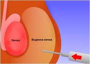 Водянка яичек у мужчин: операция и ее последствия, возможен ли рецидив гидроцеле, фото до и после