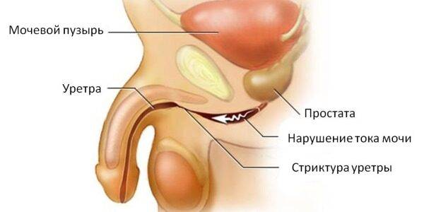 Последствие уретрита - стриктура уретры