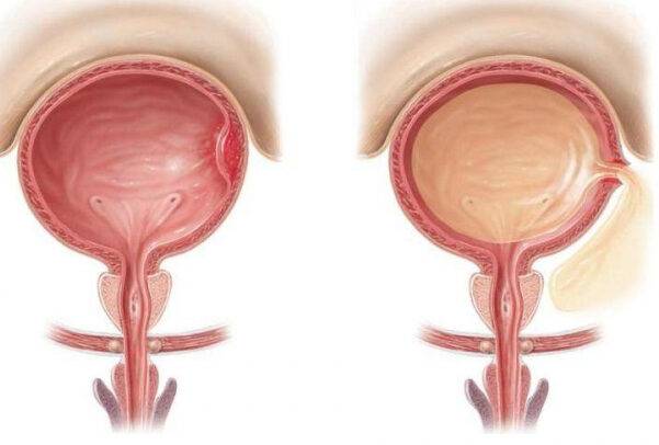 Болит мочевой пузырь - причины у мужчины и женщины, симптомы, чем лечить