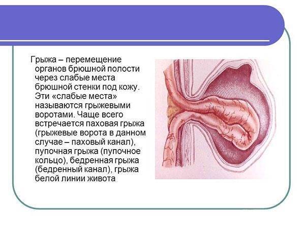 Пупочная или пупковая грыжа у мужчин: лечение без операции