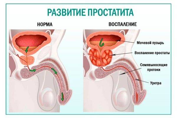 Простатит можно опознать уже на ранней стадии развития