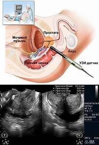 Диагностика заболеваний предстательной железы