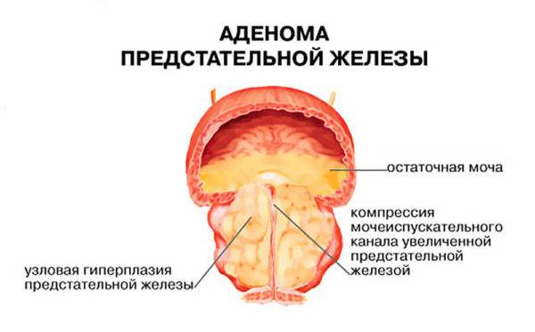 Первые проявления рака простаты схожи с симптомами аденомы