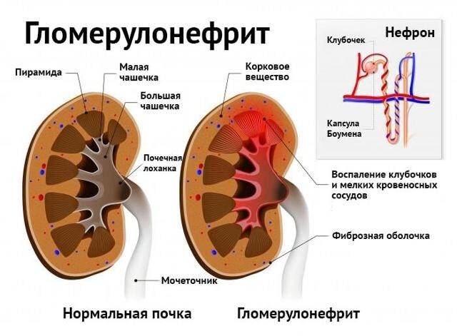 Диета при гломерулонефрите: особенности питания при хроническом и остром гломерулонефрите