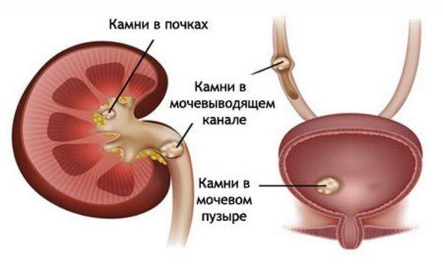 Хирургическое лечение аденомы предстательной железы. Аденомэктомия