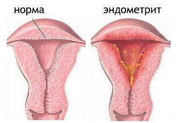 Жжение после лечения уреаплазмы