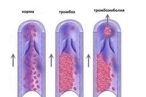 тромбофлебит