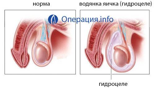 Операция гидроцеле осложнения