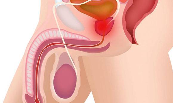 Воспаление простаты