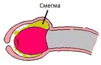 Скопление смегмы под крайней плотью у детей: причины, отличие от патологических выделений, лечение