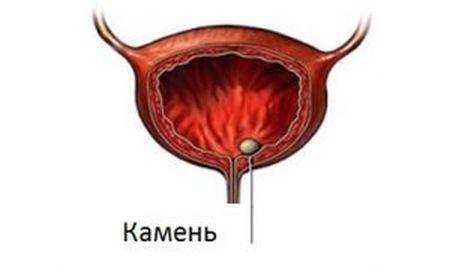 Мочекаменная болезнь: симптомы и лечение у мужчин, профилактика, лекарства