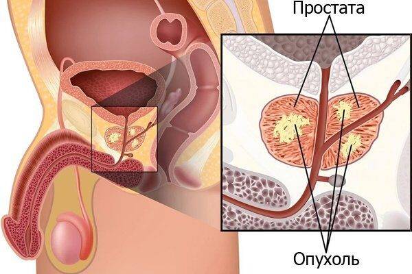 Диффузные изменения паренхимы предстательной железы: что это такое и какое лечение предстоит, а также о чем говорят повышенная эхогенность простаты, изоэхогенные и гиперэхогенные образования