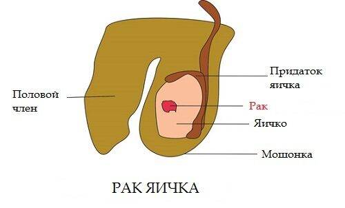 Опухли яички и болят у мужчины: причины, почему отекает мошонка, как лечить