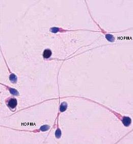 Сперматозоиды под миркоскопом при проведении спермограммы