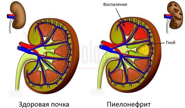 Почему моча с кровью у мужчин: причины, диагностика, лечение гематурии