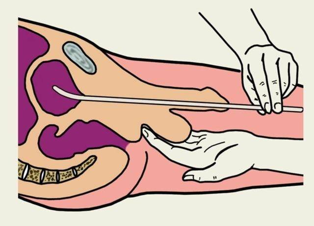 Катетеризация мочевого пузыря у женщин, техника
