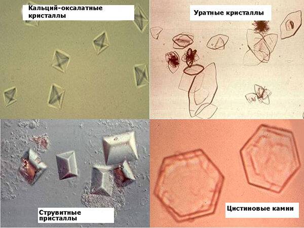 Виды камней в почках: фото, описание и методы диагностики