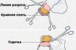 Рубец после обрезания: фото шрамов возле головки после обрезания крайней плоти, а так же больно ли снимать швы и когда рекомендуется это делать, могут ли они сами рассосаться