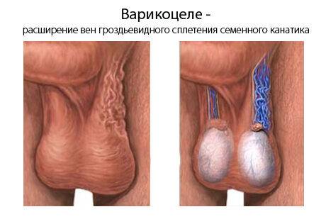 Операция варикоцеле и секс: почему нельзя сразу после процедуры вступать в половые контакты и заниматься мастурбацией, когда это возможно и сколько нужно воздерживаться