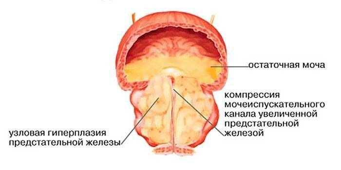 Схема аденомы предстательной железы