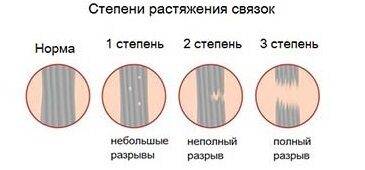 Растяжение паховых связок — лечение и тейпирование мышц паха, симптомы у мужчин и женщин