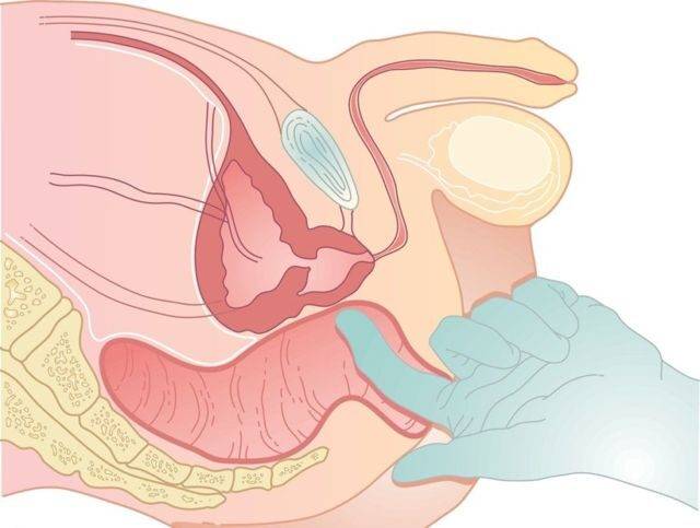 Стимуляция простаты: техника процедуры и противопоказания к ней