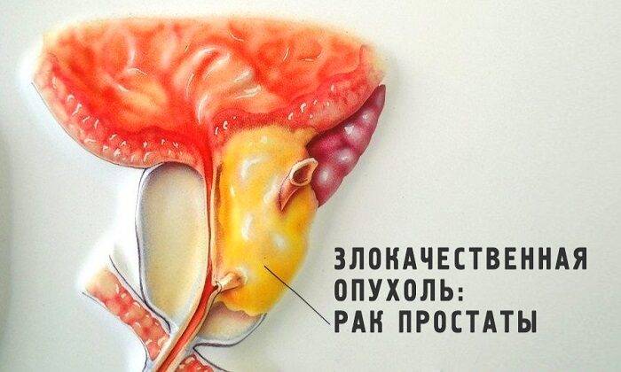 Применение разрешено в качестве профилактики рака предстательной железы