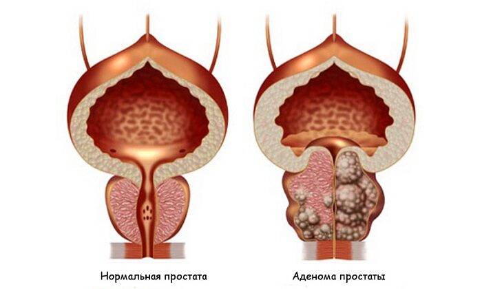 При аденоме простаты принимают Ликопрофит