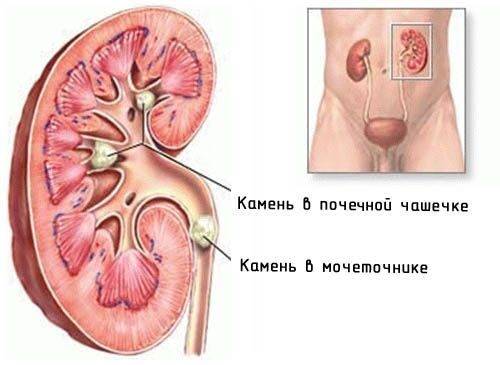 Слизь в моче: какие паталогии вызывают и что это значит