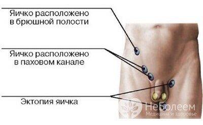 Крипторхизм - часто встречающаяся аномалия, неопущение яичка в мошонке
