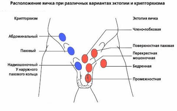 Опускание яичек у мальчиков