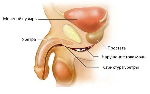 Причины простатита у мужчин: почему возникает заболевание, из-за чего бывает воспаления предстательной железы (простаты), а также что это вызывает