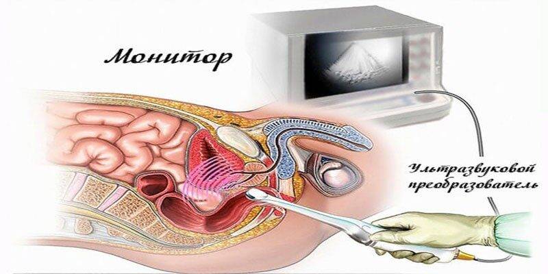 Сколько выпить воды перед узи простаты