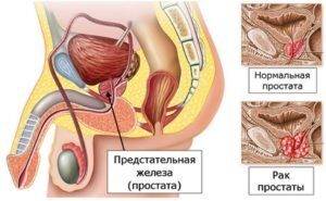 рак предстательной железы