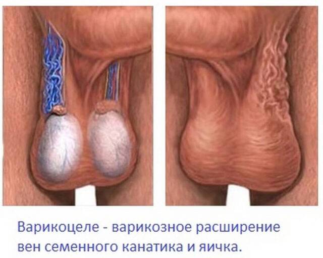 Почему болит правое яичко у мужчины