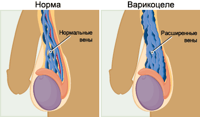 Операция варикоцеле и секс: почему нельзя сразу после процедуры вступать в половые контакты и заниматься мастурбацией, когда это возможно и сколько нужно воздерживаться