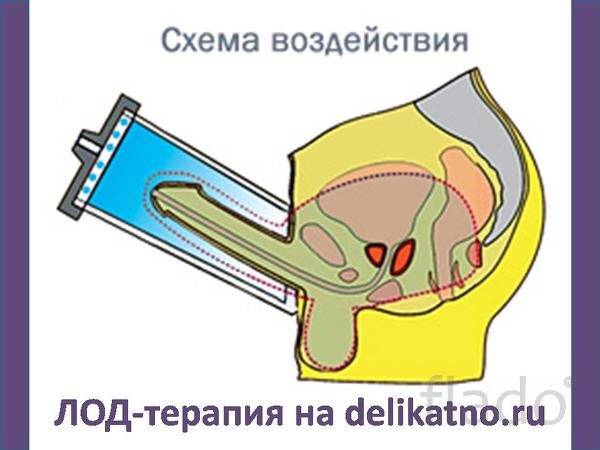 Лод терапия в урологии отзывы