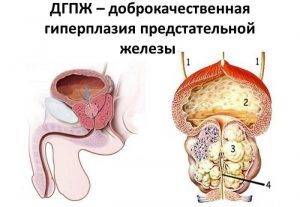 Доброкачественная гиперплазия предстательной железы