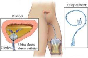 Как правильно поставить катетер в мочевой пузырь женщине или мужчине